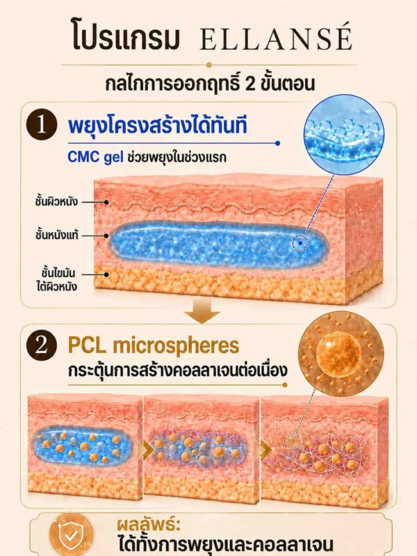 กลไกโปรแกรม Ellansé ประกอบด้วย CMC gel ช่วยเติมเต็มในระยะแรก และอนุภาค PCL ช่วยกระตุ้นการสร้างคอลลาเจน